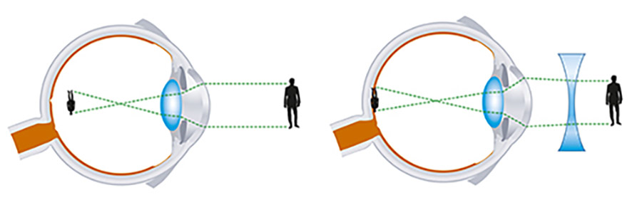 Myopie explication convergence