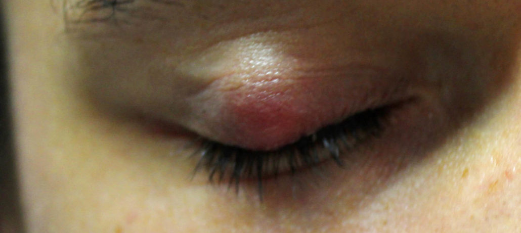 Chalazion